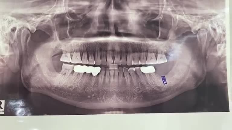 Lắp implant răng số 7 cho chú Đạo tại cơ sở TP. Thái Nguyên.
